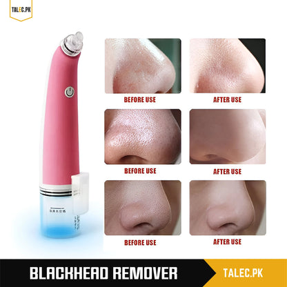 Black Head Remover